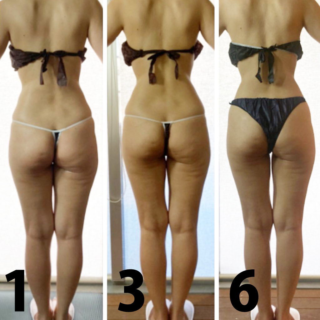 痩身エステ1回目～6回目の施術写真